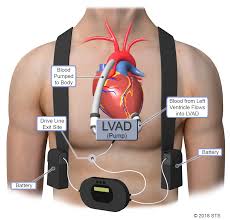 Lvad controller